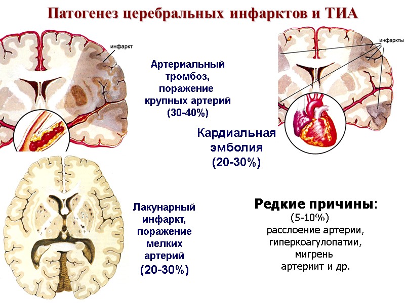 Патогенез церебральных инфарктов и ТИА Кардиальная эмболия (20-30%) Артериальный тромбоз, поражение  крупных артерий